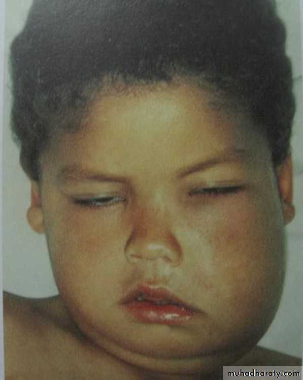 leukemia and lymphoma