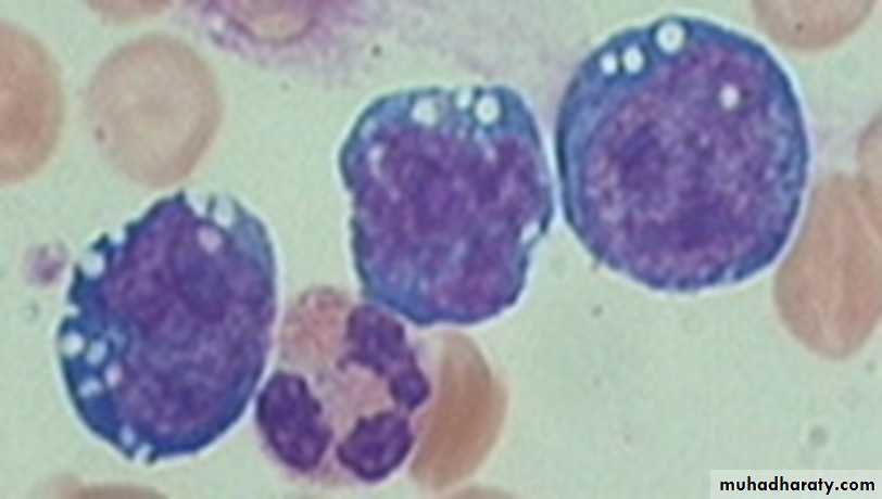 leukemia and lymphoma