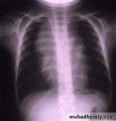 leukemia and lymphoma