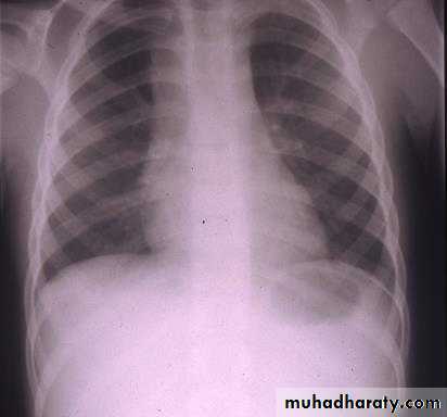 leukemia and lymphoma