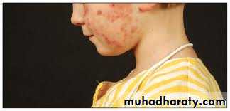 leukemia and lymphoma