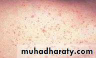 leukemia and lymphoma