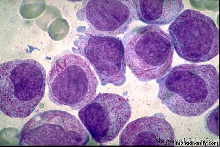 leukemia and lymphoma