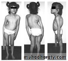 ataxia