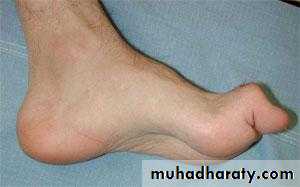 ataxia