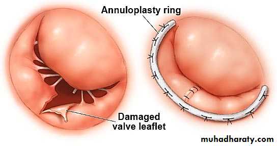 cardiac surgery