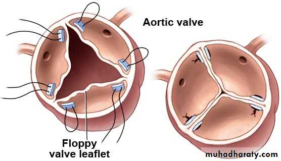 cardiac surgery