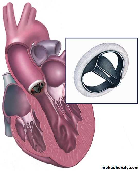 cardiac surgery