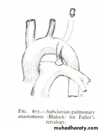 cardiac surgery