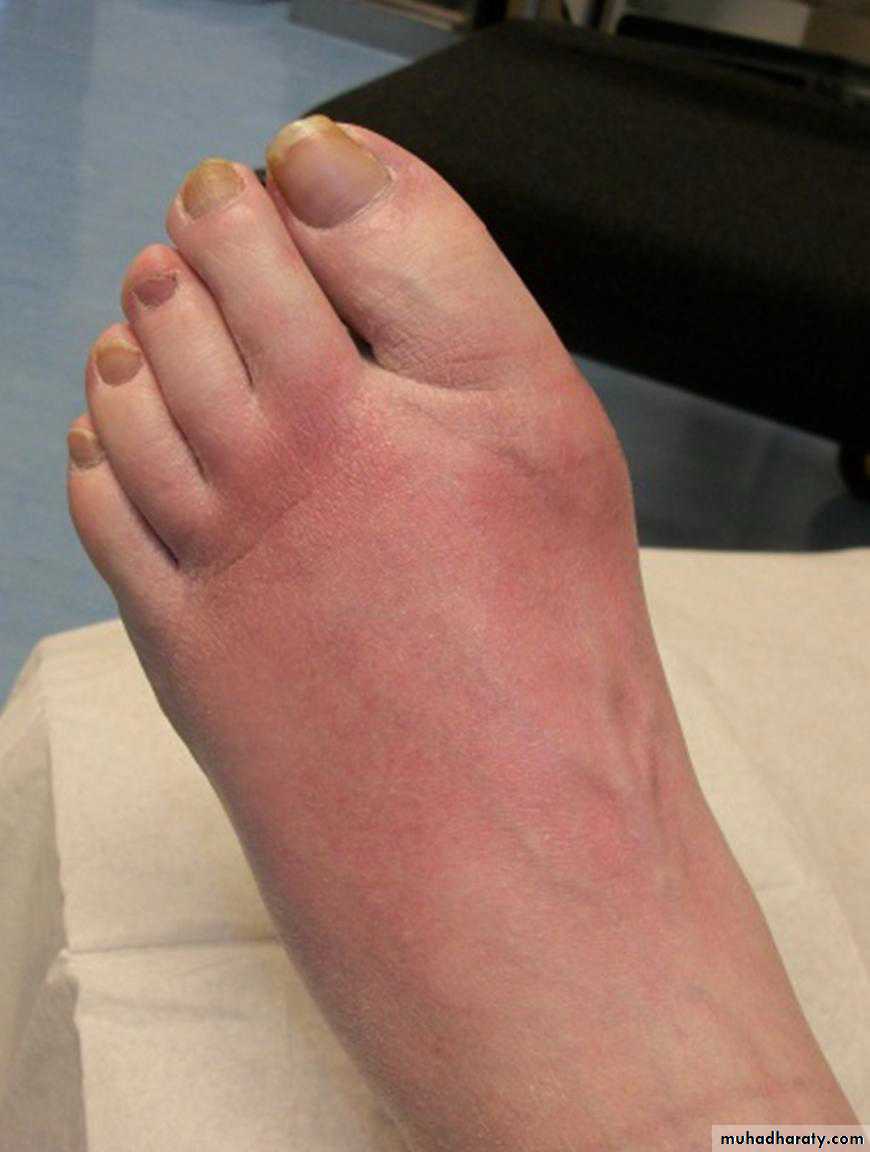Diabetes Mellitus