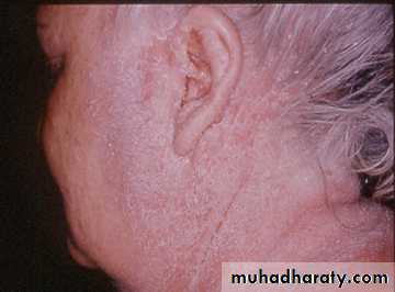 eczema2