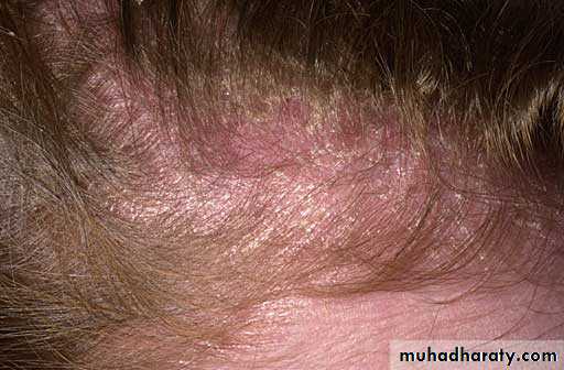 eczema2