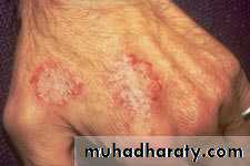eczema2