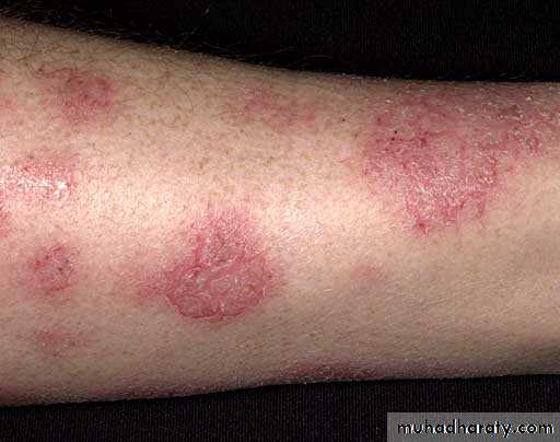eczema2