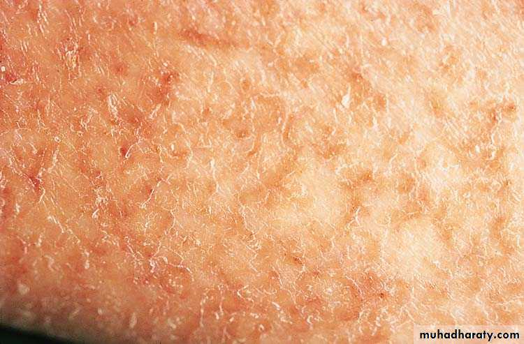 eczema2