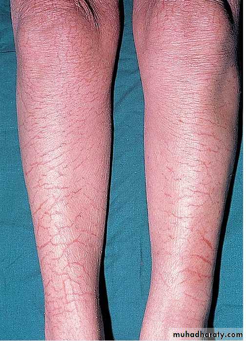 eczema2