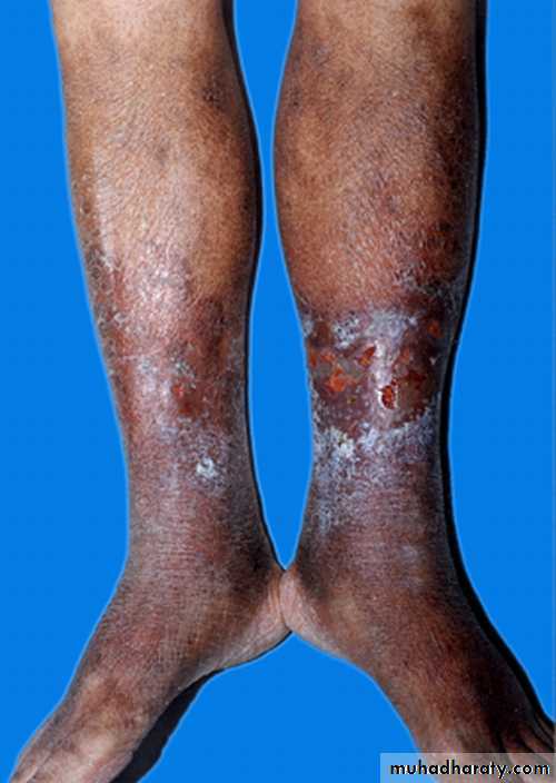 eczema2