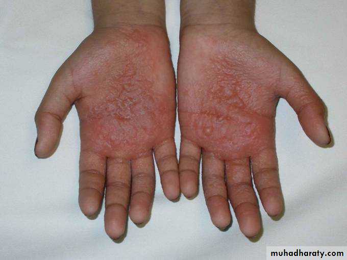eczema2