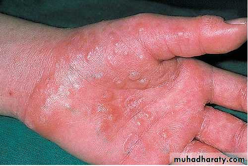 eczema2