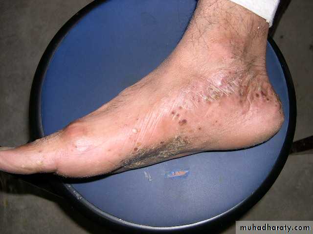 eczema2