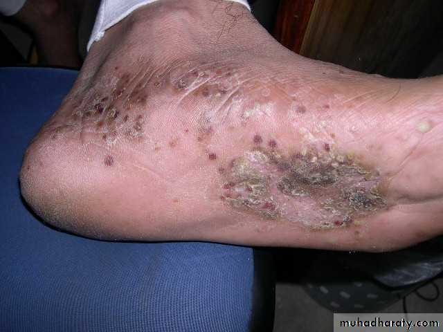 eczema2