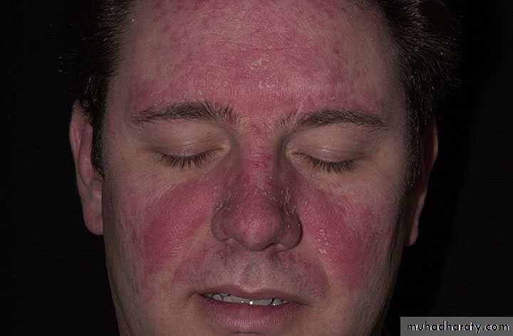 eczema2