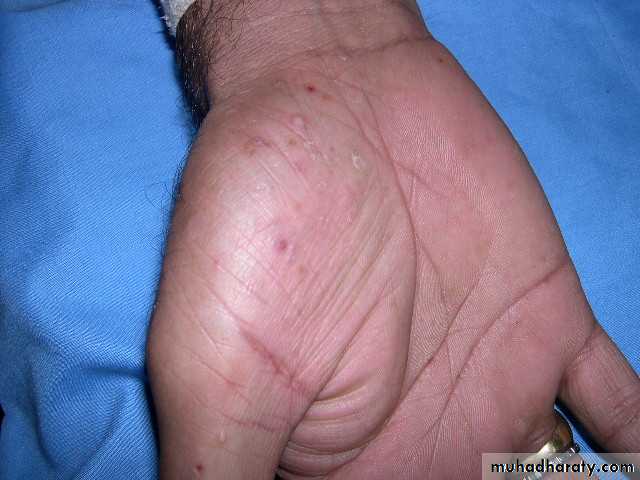 eczema2