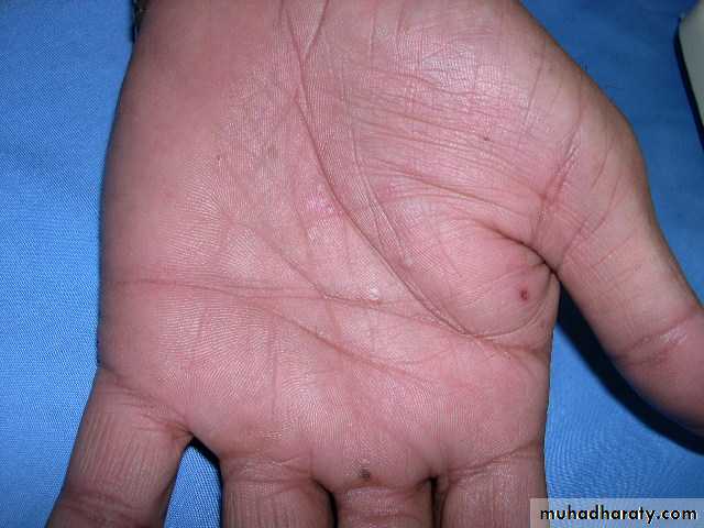 eczema2