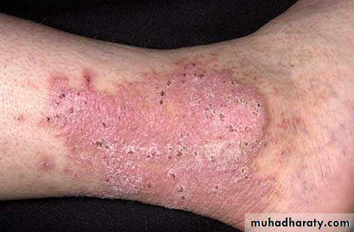 eczema2