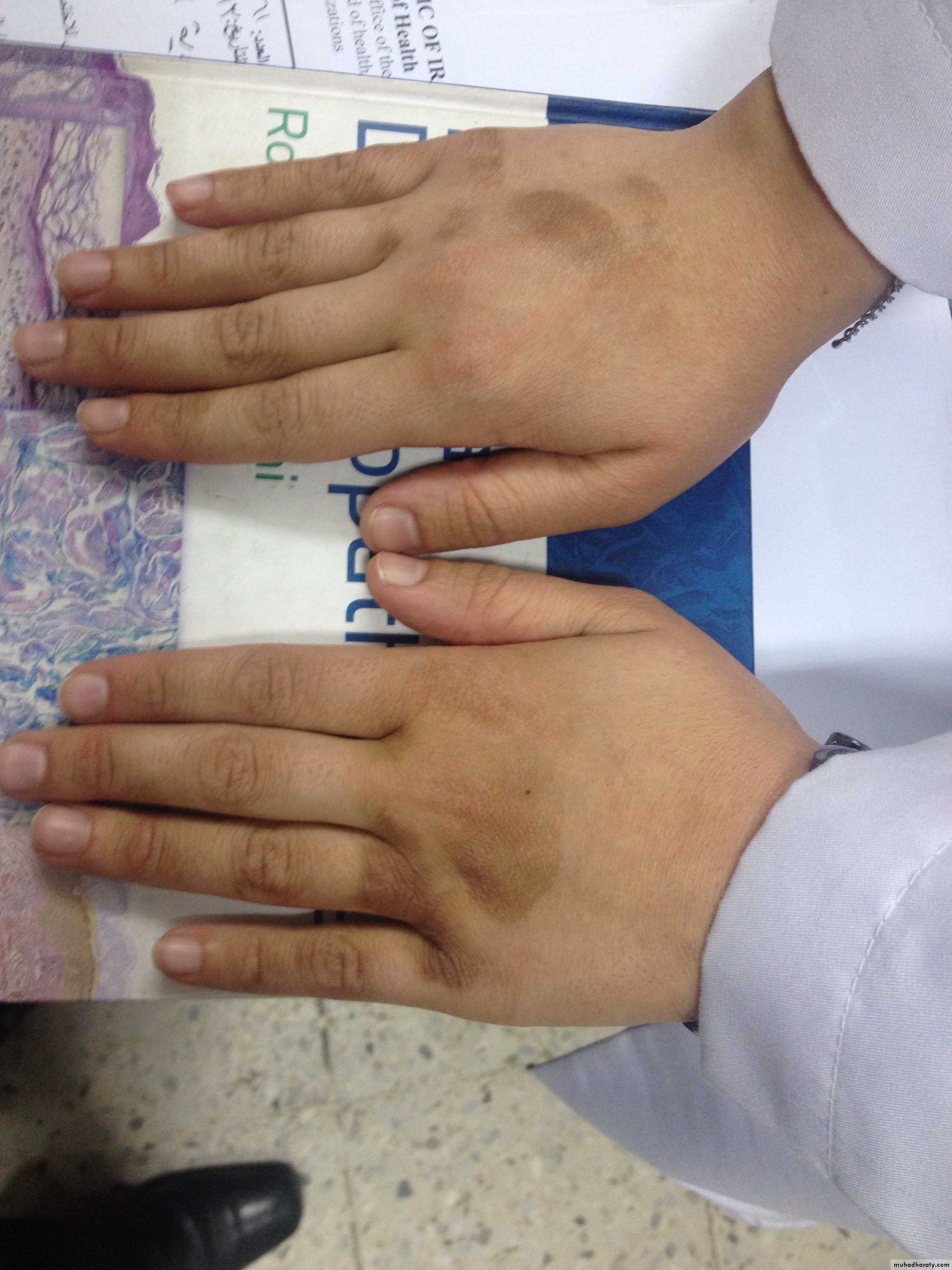 eczema2