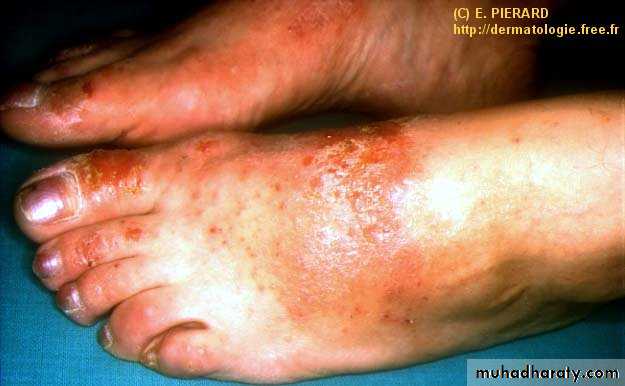 eczema2