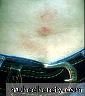 eczema2