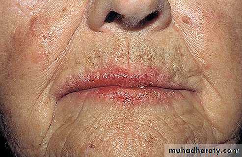 eczema2