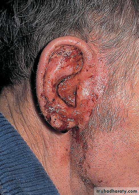eczema2