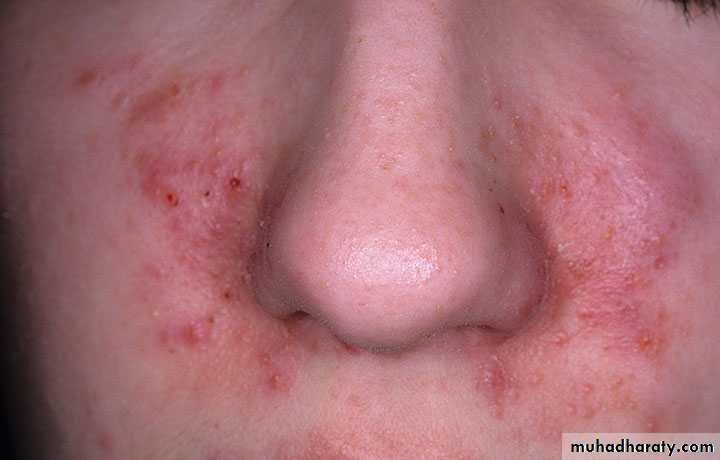 eczema2