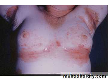 eczema2