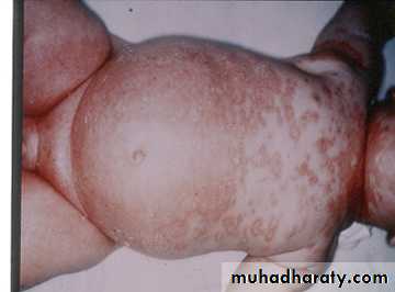 eczema2
