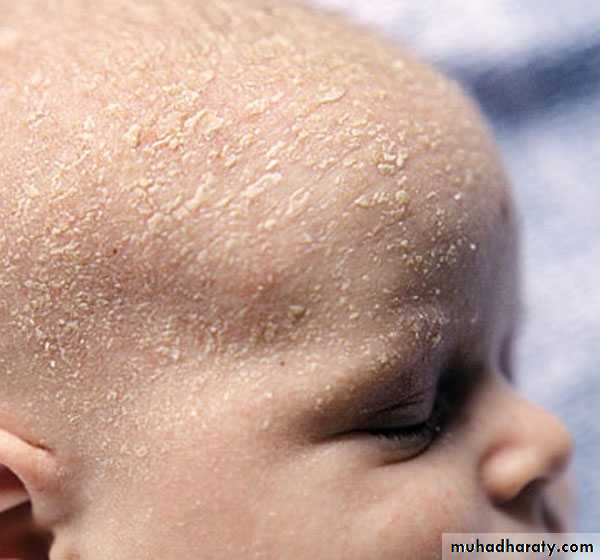 eczema2