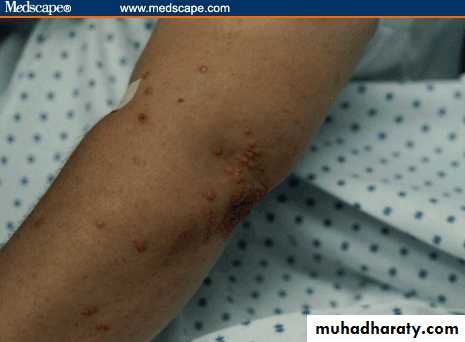 Infectious