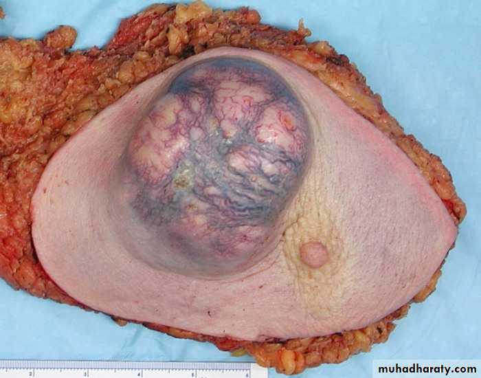 breast cancer