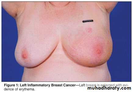 breast cancer