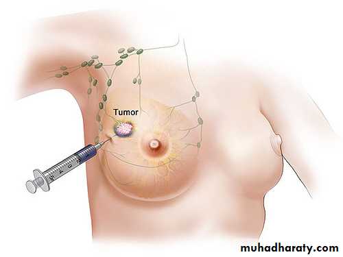 breast cancer