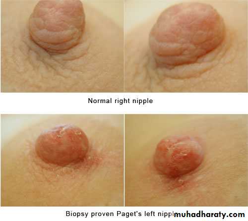 breast cancer