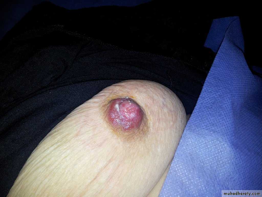 breast cancer