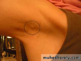 breast cancer