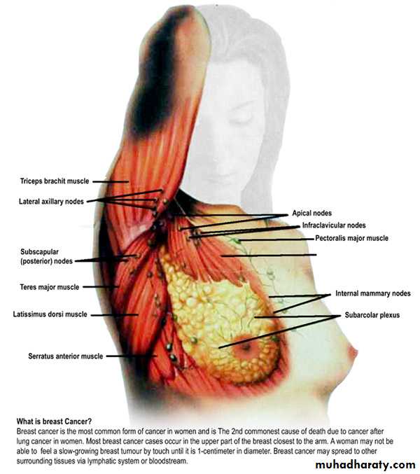 breast cancer