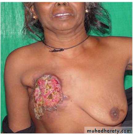 breast cancer