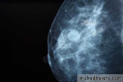 breast cancer