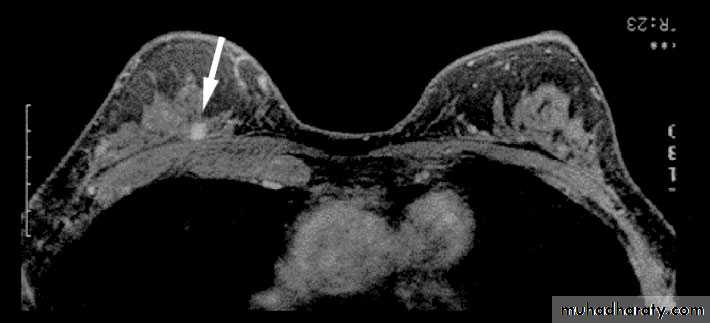 breast cancer