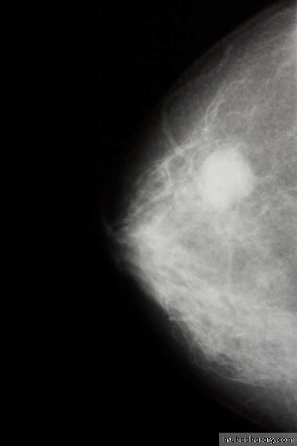 breast cancer